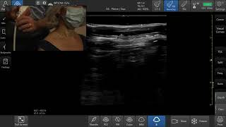 ICCNMI2021  Anatomy and scan demo of the small nerves in the neck [upl. by Ayoral520]