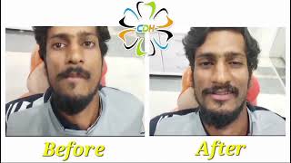 Lower jaw dislocation before and after DrchakinalaDentalHospital beeramguda hyderabad7587162810 [upl. by Nairadal]