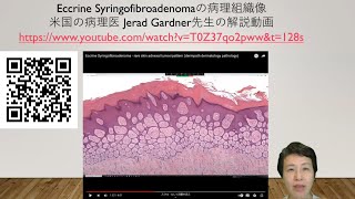 eccrine syringofibroadenomaの病理組織像の解説 [upl. by Melesa43]