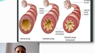 BRONCHIAL ASTHMA [upl. by Riha]