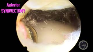 SYNOVIAL PLICA IN LEFT KNEE [upl. by Bradway]