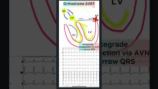 WPW phenomenon and WPW syndrome [upl. by Renado]