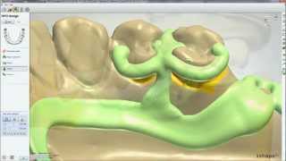 Dental System™ 2012  Removable Partial Design [upl. by Oilisab670]