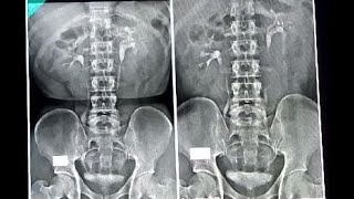 IVU Intravanous urography Radiography বাংলা ভাষা [upl. by Nayd]