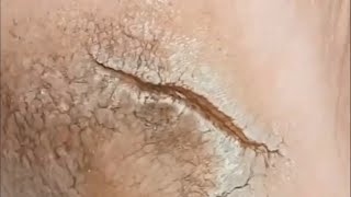 Pedicure video35，A large tear in the heel，vertical plantaris，plantar wart [upl. by Carnay722]