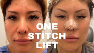 One Stitch Lift™ SCARLESS FACE LIFT [upl. by Salb]