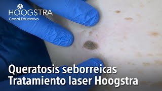 Queratosis seborreicas  Tratamiento laser Hoogstra  22134 [upl. by Slavin]