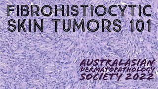 Fibrohistiocytic Skin Tumors 101 Australasian Dermatopathology Society 2022 meeting pathology [upl. by Hsinam]