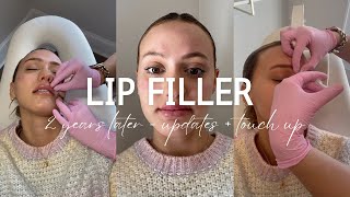 LIP FILLER VLOG Healing process  my experience after 2 years [upl. by Eblehs547]