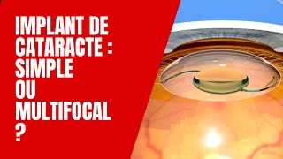 Cataracte Comment choisir entre Implants simples ou multifocaux [upl. by Vivica]