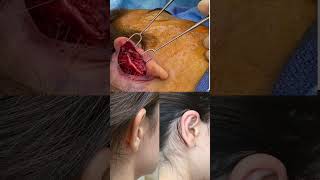 EAR RESHAPING OTOPLASTY TRANSFORMATION [upl. by Leemaj]