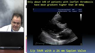 Paravalvular Leak Valve Thrombosis and More  Dr Stamatios Lerakis [upl. by Nathanael]