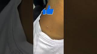 Easy way to remove pimples pimple [upl. by Okimat]