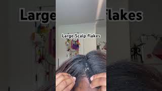 Removing flakes from scalp [upl. by Urbanus]