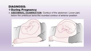 Occipito Posterior pregnancy by DrMeeta Patel GMC Bettiah [upl. by Ettenej]