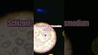 Schizont stage of Plasmodium falciparum  Malarial Parasitology [upl. by Bailar]