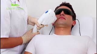 Depilazione Laser Londei Clinic [upl. by Germayne]