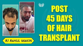 RJ Rahul Makins Post 45 Days Hair Transplant Review  Medlinks  Best Hair Transplant Clinic [upl. by Harlan]