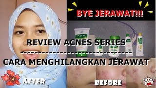 CARA MENGHILANGKAN JERAWAT REVIEW ACNES SERIES  BY KHAIRUNNISA ADLINA [upl. by Alimak]