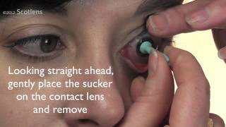 GP contact lens removal with sucker [upl. by Winnah]