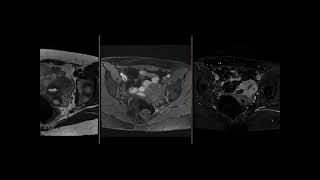 Cystic adenomyoma [upl. by Krystal26]