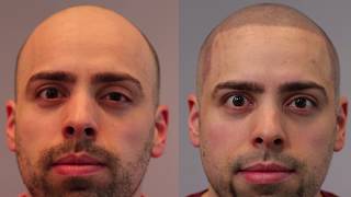 Before  After Scalp Micropigmentation  Matt Visits Hairline Ink Chicago [upl. by Lihas696]