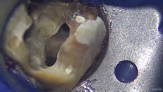 Microscopic Retreatment of maxillary molar with 2 palatal roots [upl. by Joane900]