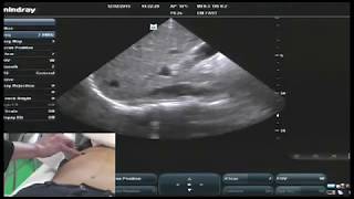 Hot Tips  IVC Volume Assessment with Ultrasound [upl. by Arev]