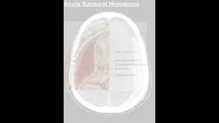 subdural hematoma 3d animation  Acute subdural hemorrhage ct scan  subdural hematoma radiology [upl. by Cruz763]