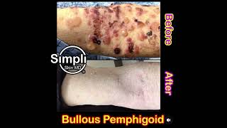 Bullous Pemphigoid Before and After [upl. by Etienne]