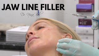 Jawline Filler Before and After 💕Jawline Transformation with Dr Nina Bal 💕 Jawline Filler Experience [upl. by Hamas]