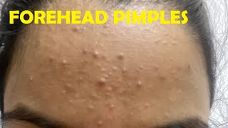 how to get rid of pimples on forehead overnight step by step [upl. by Aticilef]