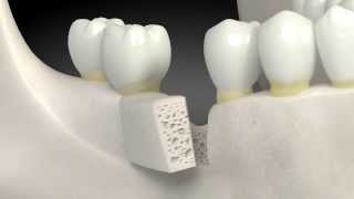 What is a dental bone graft [upl. by Elga751]