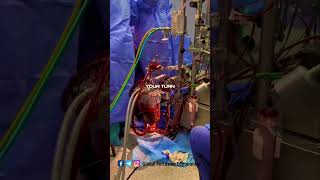 Perfusion aspects by a clinical Perfusionist perfusion nurse [upl. by Ear22]