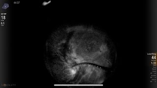 PDR management Intraoperative FFA Lukan Mishev live stream [upl. by Hasila733]