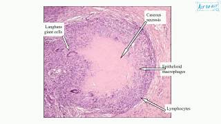 caseous necrosis English  Medical terminology for medical students [upl. by Samaj]