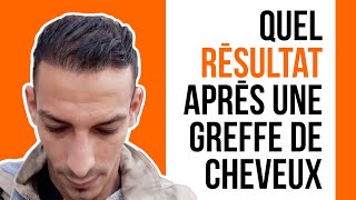 Greffe de cheveux Turquie résultat avant après 12 mois  Turkisme Medical [upl. by Helge894]