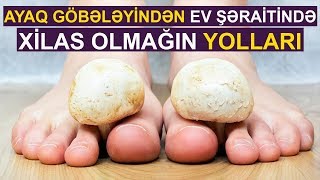 Ayaq göbələyindən ev şəraitində xilas olmağın yolları [upl. by Steffy81]