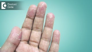 Ways to manage peeling of skin from hands  Dr Sudheendra Udbalker [upl. by Manfred]