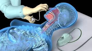 Nasotracheal suctioning NTS  3D animation [upl. by Nessej524]