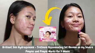 I tried Brilliant Skin Hydroquinone  Tretinoin Rejuvenating Set on my Severe Pimples amp Pimple Marks [upl. by Pavlish]