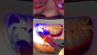 Teeth whitening process [upl. by Roxine]