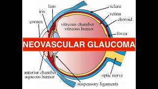 neovascular glaucoma  etiology causes course treatment [upl. by Ginsberg]