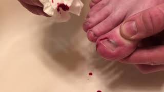 Guy Drills A Toenail with a Drill Subungual Hematoma Blood Warning Blood Under Nail [upl. by Borroff]