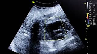 CÓLICO RENAL POR HIDRONEFROSIS Y ECTASIA RENAL DERECHA DOLOR DE RIÑÓN [upl. by Clarinda]