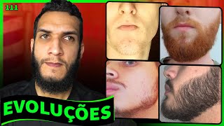 EVOLUÇÕES COM MINOXIDIL  BARBA ANTES E DEPOIS 111 [upl. by Bartholomeus]