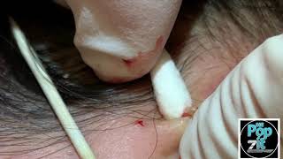 Your new favorite extraction video part 1 Blackheads whiteheads milia Over 20 minutes of pops [upl. by Redla]