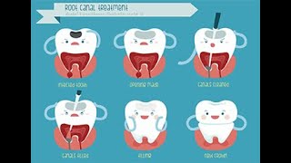 pulpotomy of primary tooth [upl. by Petey]