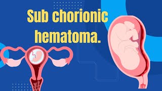 Sub chorionic hematoma Dr Sireesha [upl. by Anwahsak]