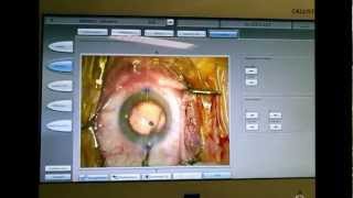 CALLISTO Eye system  Chirurgie de la cataracte Dr Coullet Montpellier [upl. by Kartis]